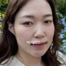 인디언걸 | 김해피부과 콜라레쥬 인디언주름 콜라겐 주사 맞고 온 후기