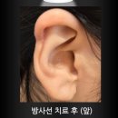 미래항외과의원 | 용인 수지 분당 판교 귀 켈로이드 비용 내고 방사선까지 한다면 이것도 생각해 보셔야 돼요.