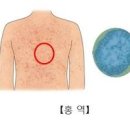 홍역 예방접종 홍역 원인 증상 치료 성인 홍역 이미지