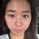 남순천의원 | 순천 결혼 전 피부 관리 순천청담리즈의원 후기 1회차(기미 / 잡티 / 붉은 점)