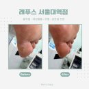 서울대입구 5번출구 | 신림 발각질 관리로 아기발 된 후기 레푸스 서울대입구점