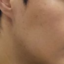 예쁨주의쁨의원 | 천안예쁨주의쁨의원 | 천안피부과 필로드 후기