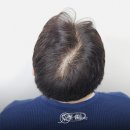 JK메디칼 | "결혼 앞두고 정수리 두피문신 받았습니다" [정수리] 두피문신 후기