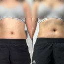 삼일의원 | 상상만 하던 다이어트 지방분해주사의원에서 해결 복부 5회차 마지막후기