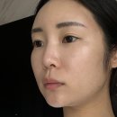 내리길 | 비순각교정(비주내리기), 비개방으로도 충분합니다! (+코젤코후기)