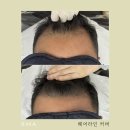 매직헤어라인 이미지