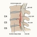 변형성 경추증 (Cervical Spondylosis)의 병태생리와 치료 전략 이미지