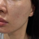 재인필라테스 | 창원피부과 내생에 첫 리쥬란힐러 1주일 후기 (효과 및 통증 / 엠보관리 일상생활가능 )