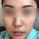 미앤지의원 | [서울/중랑] 사가정역 미앤지의원 여드름 레이저치료 5차 마지막 후기