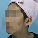 안산여드름흉터 한의원 새살침 치료 고민이라면