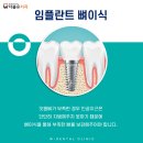 더블유치과의원 | 임플란트 뼈이식 통증 기간, 언제까지 아플까요?