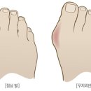 엄지발가락 바깥으로 휘는 이 질환…여성에게 더 많아 이미지