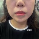 더고운의원 | 충주 내돈내산 입술필러 무턱필러 턱보턱스 더고운의원