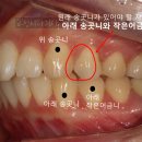 네모치과의원 | 괜찮을까요? 한쪽만 발치하여 돌출입 무턱 개선한 후기. 편측발치 교합 형성 방법. 송파구 교정치과