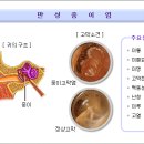 만성 중이염 이미지