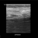 좌하복부 complex echoic lesion 이미지