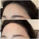 홍 헤어라인 | 대구 페이스 왁싱 잘하는 브라질홍, 헤어라인 이마 왁싱