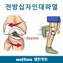 전방십자인대 파열 // 전방십자인대 파열 치료// 관절내시경 이미지