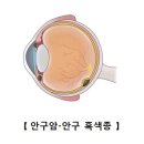 안암[eye cancer눈질환, 종양혈액질환] 이미지