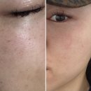 역삼약국 | [서울] 역삼역 기미 잡티 제거 제로스팟 클리어스팟 &#39;미작뷰티 강남본점&#39;