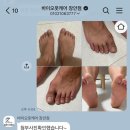 장안제일약국 | 미루고 미루던 무좀, 하루빨리 스케일링 받으세요 - 답십리 바이오 풋케어