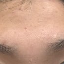 가로세로한의원 | [내돈내산] 가로세로한의원에서 흉터치료 새살침(서브시전) 맞은 후기