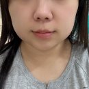 핏모아 | 수원 인계동 티타늄리프팅 40kj 슬림핏주사 세모아의원 일주일 후기