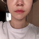 청담포레브의원 더브이 티타늄리프팅 동안페이스 만들기(가격, 효과 후기)