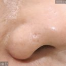 회룡한의원 | 회룡역 피부과 회룡 근처 한의원 여드름 모공 흉터 코 새살침 치료 후기