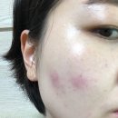 남포고운피부과의원 네이버블로그