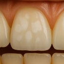 산들치과의원 | 충치 치료 로 이어지기 전 주의하세요, 태평역 치과 에서 설명해 드리는 치아 탈회의 원인과 예방법에...