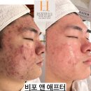 카페더하리 | 자존감바닥에서 민낯으로 소개팅까지/영천피부관리 더하리 여드름 후기