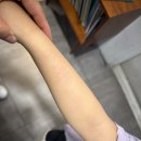 화염상모반 치료 후기 마포공덕에스앤유 피부과 병원 정보