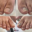 강남리더스약국 | 강남 일원동 남자발관리샵, 남자발톱무좀관리 후기