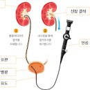 요로결석 원인 증상(통증) 제거방법과 예방에 좋은 음식 이미지