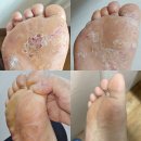 라파엘약국 | 라파엘크림 발 무좀 항진균 연고 사용 후기