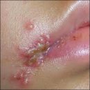 아마의 맹점 | 헤르페스 완치 방법 후기