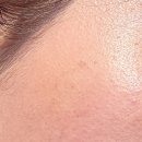 양성한의원 | 편평사마귀 제거 후기｜한의원 레이저 시술 비용부터 실비·세안·회복까지 정리