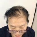 엠블랙 | 정성 가득 두피 밀도보강, 엠블랙에서의 하루