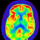 비정형 파킨슨 증후군[Atypical Parkinsonism]뇌신경정신질환 이미지