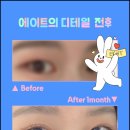 압구정서울성형외과 네이버블로그