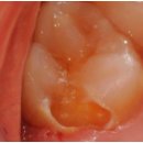 곧은치과의원 | 온의동치과, 3,000만 원짜리 치아 수명 늘리고 싶다면? <15년 차 의사의 팁> [레진, 충치치료]
