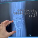 전방 십자인대 휜 다리 교정술 (절골술) 천공술 서울 점프 정형외과 수술 후기 비용, 통증