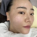 증도가 | 공덕피부과 레이저토닝 리쥬란힐러 효과 두배인 후기