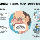 이석증을 치료했더니 비행기를 탈 수 있을 것 같아요.