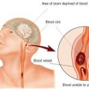 뇌졸중 이미지
