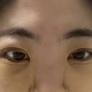 만인요양병원 | 절개 쌍수 재수술+눈매교정+눈밑지방재배치 / 일주일차 후기 (사진 주의)