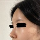 (주)상상초월 | 내돈내산 이마필러 부작용 녹이기 당일~일주일 후기