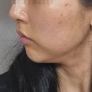 청담의원 | 고민 끝에 선택한 청담 모즈의원, 솔직 후기 / 내돈내산 /가격공유