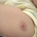 해외출생 아기 BCG 결핵주사, 늦게 맞으면 생기는 부작용? 고름 생긴 아기 후기